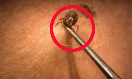 Scary: Girl got paralyzed after a Tick Bite, in Summers its increasing